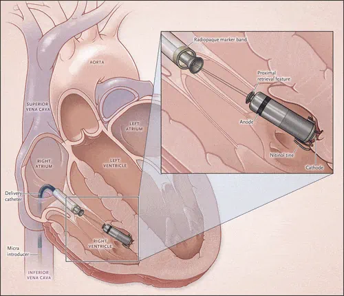 Schéma d'implantation du pacemaker Medtronic Micra